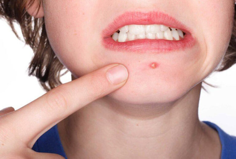 Da mụn nên tránh những loại thực phẩm nào?